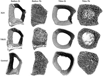 Bone Volumetric Density, Microarchitecture, and Estimated Bone Strength in Tumor-Induced Rickets/Osteomalacia Versus X-linked Hypophosphatemia in Chinese Adolescents